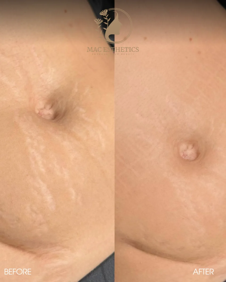 Supplied before-and-after photos of a client's abdomen following an algae peel at Mac Esthetics