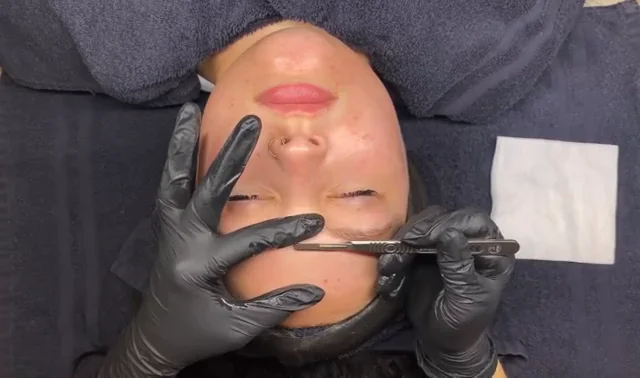 Dermaplaning treatment at Mac Esthetics