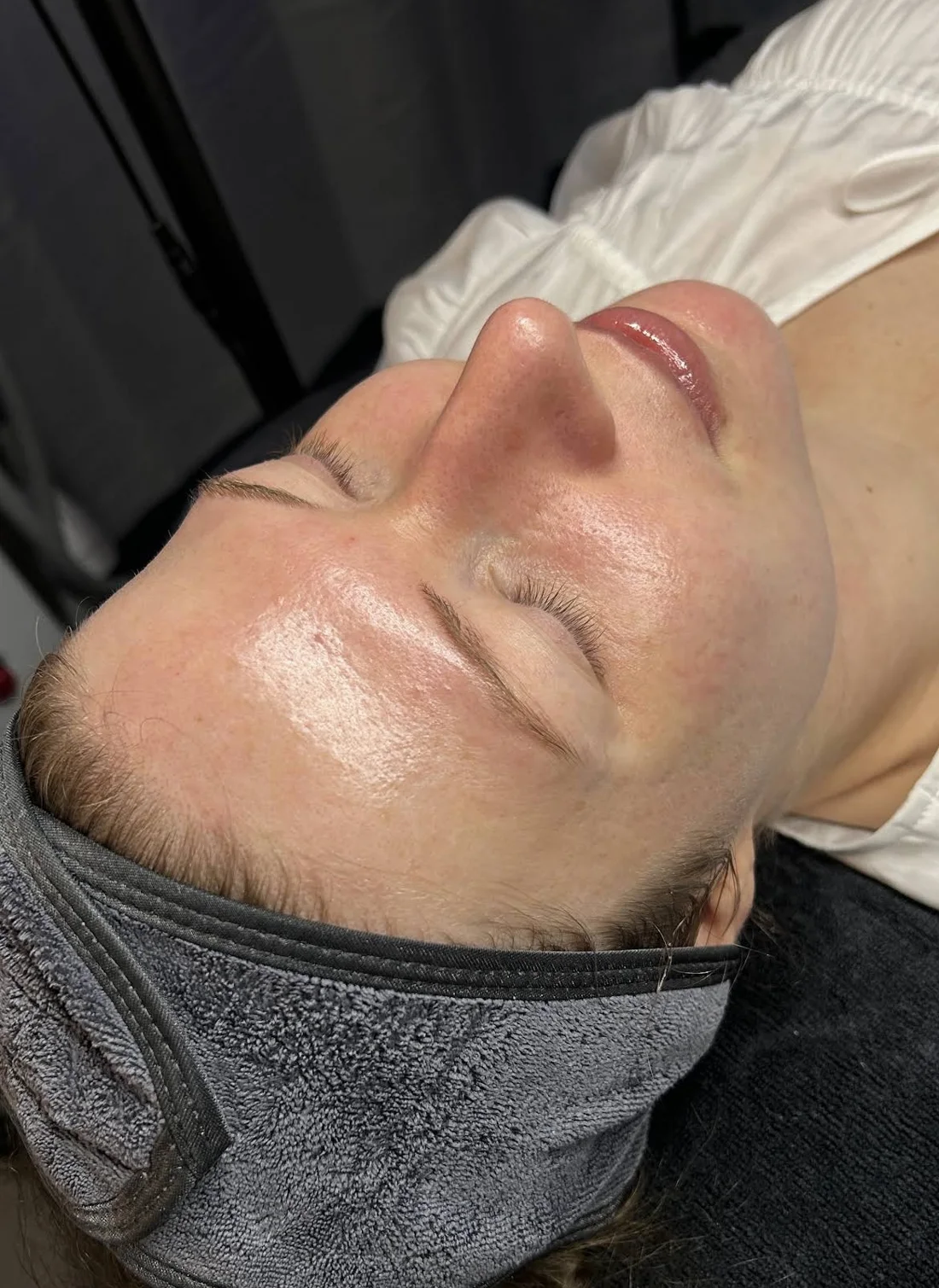 Client's skin after dermaplaning at Mac Esthetics