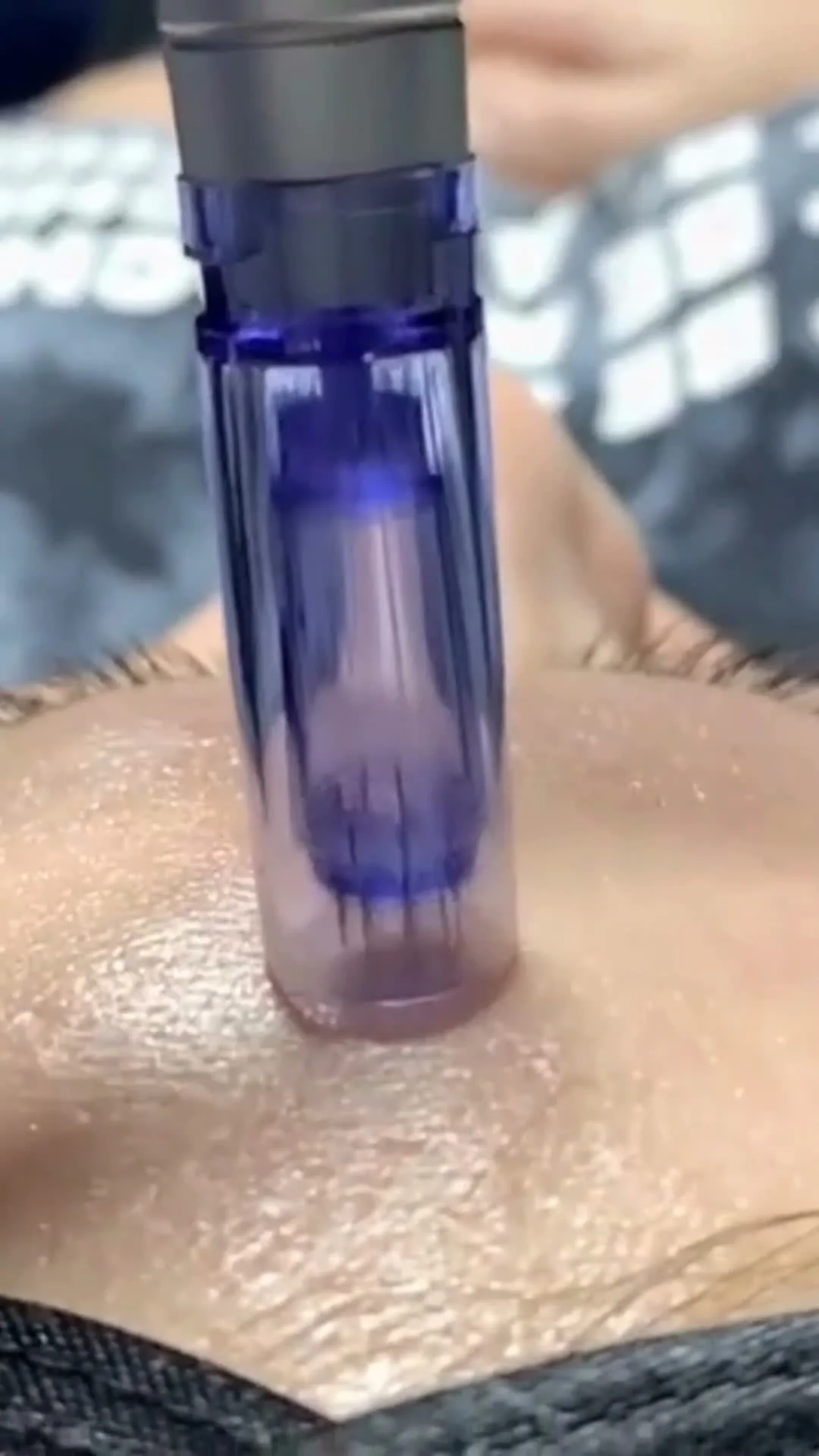 Close-up of a microneedling treatment at Mac Esthetics